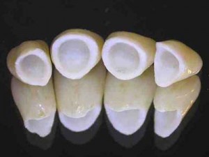 All Ceramic(IPS e.max CAD)