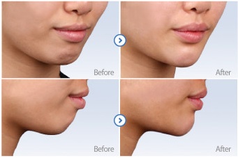 Cross-linked Dermal filler