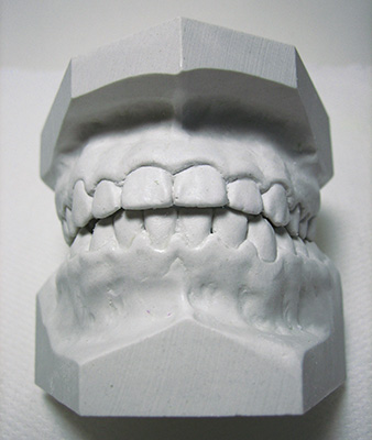 Mouth Guard Study Model