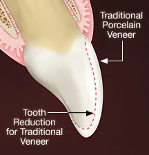 Fixed Restoration Lumineers Veneers