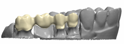 Porcelain Fused To Zirconia