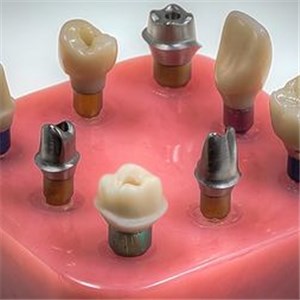 Customized Abutment