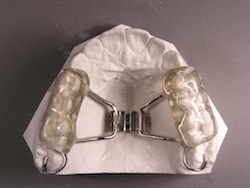 Bonded Rapid Palatal Expander