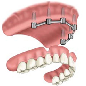 Implant Overdentures