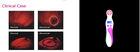 Chargeable Battery Hand Held Breast Light Scanner For Detection Of Breast Cancer